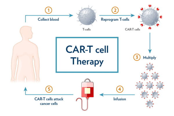 Navigating Long-Term Toxicities of CAR T-Cell Therapy CAR T - Cell Therapy
