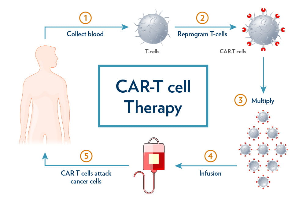 CAR T - Cell Therapy